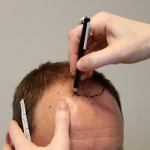 Hair Transplant in Islamabad: Restoring Confidence and Natural Beauty