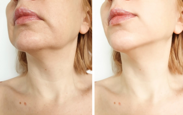 Radiant Skin Redefined: The Power of Laser Skin Tightening