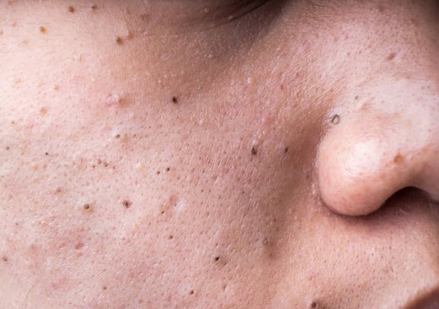 How to Get Rid of Blackheads: Tips for Clearer Skin