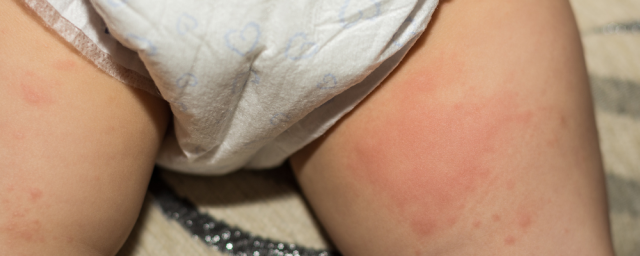 7 Effective Tips On How To Avoid Diaper Rash