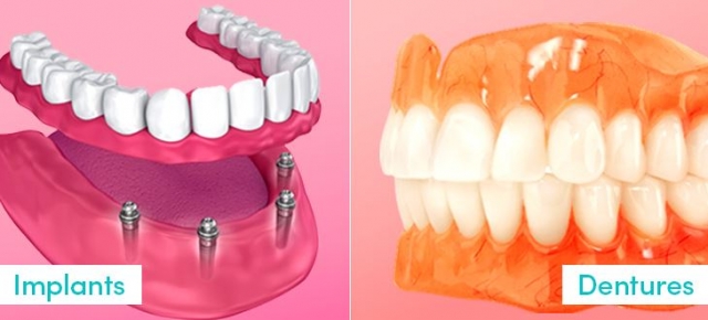 Dental Implants