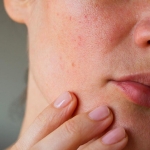 The Benefits of Chemical Peels for Large Pores
