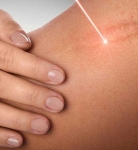 Breaking Down the Types of Scars: How Laser Treatment Targets Each