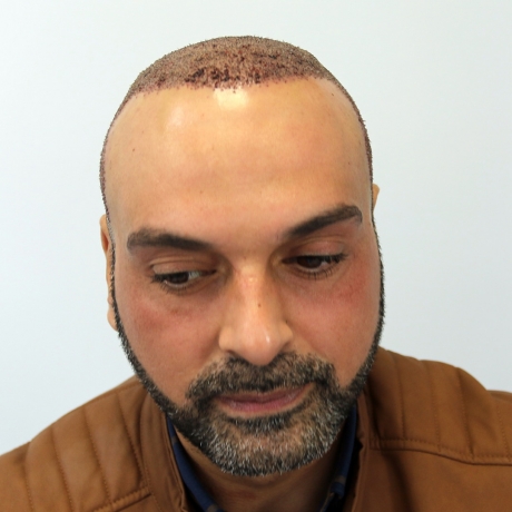 Transform with Confidence: Hair Transplant in Islamabad