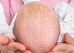 Natural Remedies for Cradle Cap in Infants