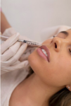 Plump and Pout: Your Guide to Stunning Lip Fillers in Birmingham
