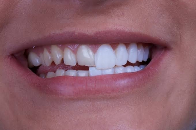 Unlocking Smiles: The Ultimate Guide to Porceln Veneers