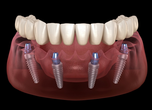 ¿Cuál Es La Necesidad De Los Implantes Dentales?