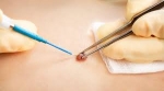 Dubai's Finest for Wart-Free Skin