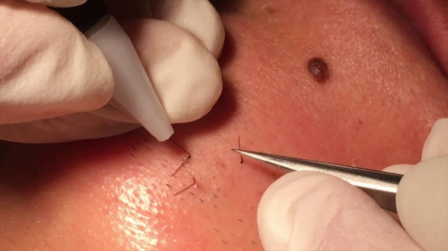 The Benefits of Electrolysis Hair Removal