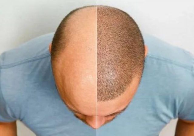 Is non-surgical hair restoration effective?