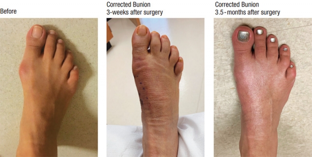 Bunion Treatment in Singapore: Finding Relief for Foot Pain