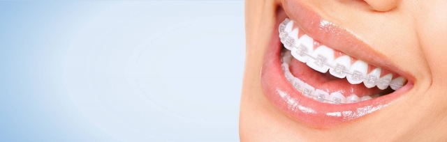 The Ultimate Guide to Choosing the Best Clear Braces for Adults