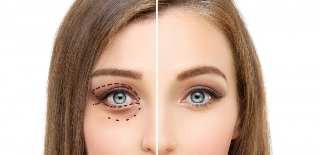 Benefits and Results of Eyelid Surgery