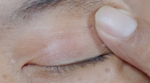 Understanding Skin Tags Around Eyes: Causes, Treatment, and Prevention