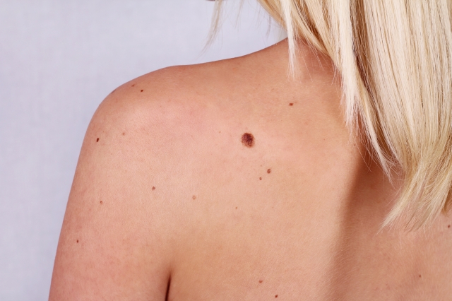 Everything You Need to Know About Mole Removal Surgery