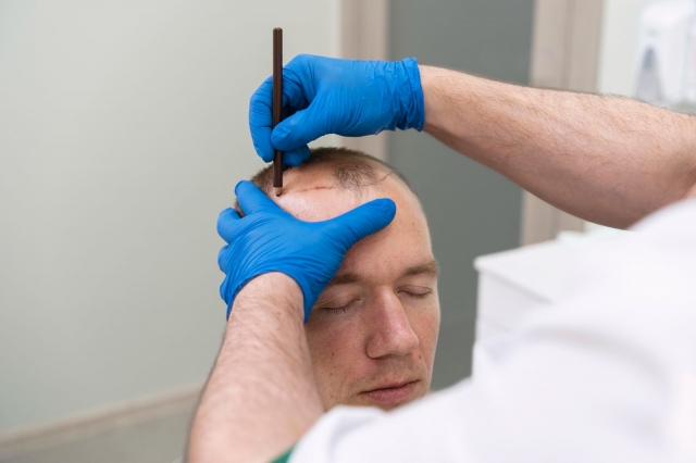 Seamless Hair Transplant Experience in Turkey
