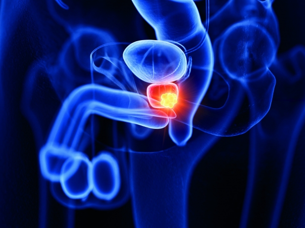 Recognizing the Signs and Symptoms of Metastatic Prostate Cancer