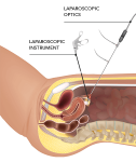 Precision in Practice: Mumbai's Renowned Laparoscopy Surgeon Sets the Standard!