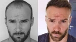 Hair Revival Revolution: Journeying Through the Best Hair Transplant Clinics in India
