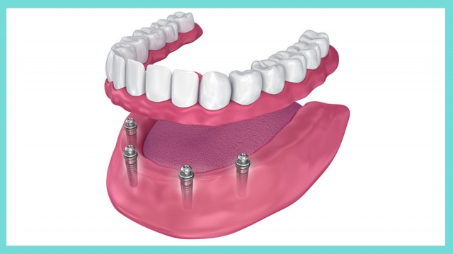 Are All-On-4 Dental Implants Worth The Money?