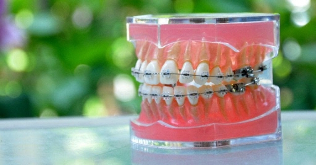 Dental implants – What are the benefits you need to know?