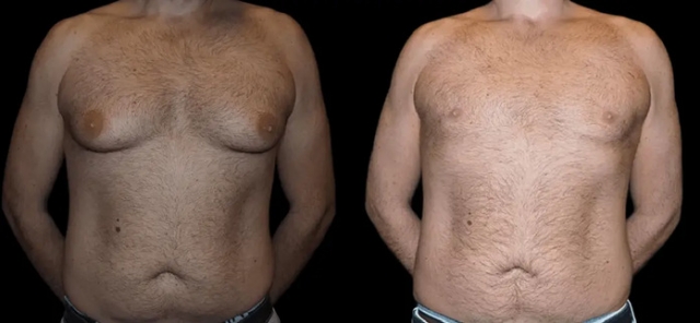 Male Breast Reduction, Power of Male Breast Reduction,