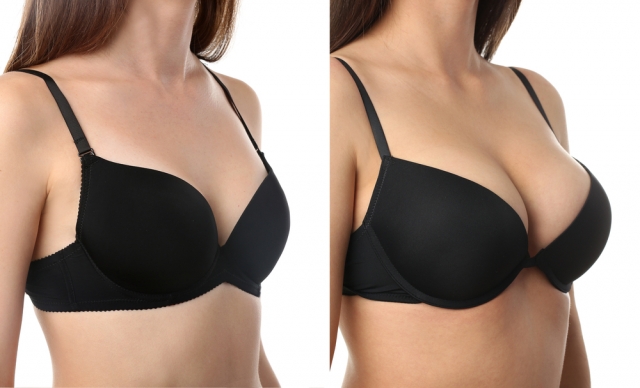Beautiful Results: Breast Augmentation in Riyadh