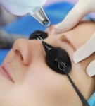 What Are the Potential Side Effects of Laser Treatment for Nevus of Ota?
