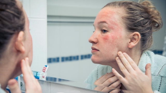 Relief OTC Moisturizer for Dermatitis