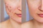 Investigating Glutathione's Impact on Skin Health