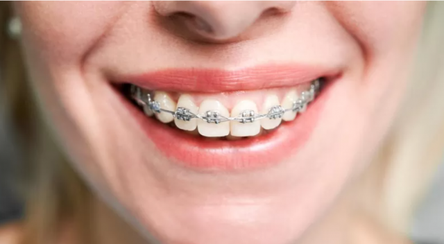 Dental braces in abu dhabi