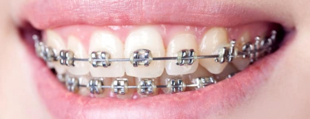 Dubai Braces Price Match Guarantee: Finding the Best Deal on Your Treatment