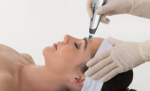 Transform Your Skin with Dermapen Microneedling at Halcyon Medispa, London