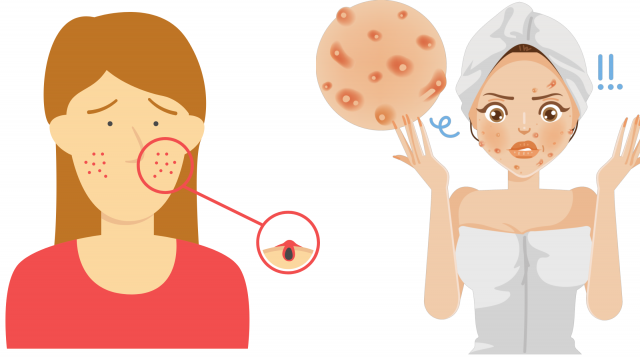 Acne Treatment Everything you need to knonw