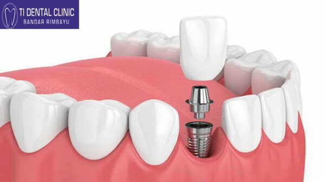 Teeth Veneer Cost: Factors That Influence the Price at Tidental