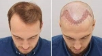 Hair Transplantation for Women in Abu Dhabi