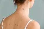 Is Mole Removal Painful? A Guide for Dubai Patients