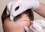 Hair Transplant Aftercare Essentials for Dubai Residents