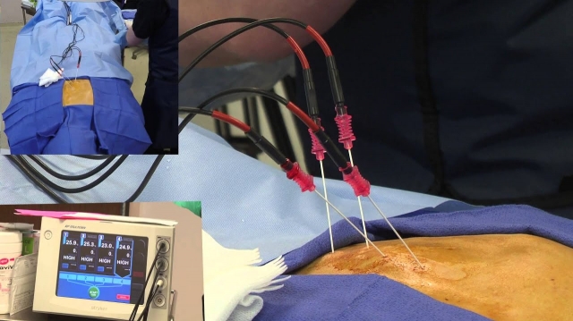 Radiofrequency Ablation Devices Market Overview, Growth, Trends and Forecast by 2031