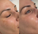 Dermal Fillers Treatments in London