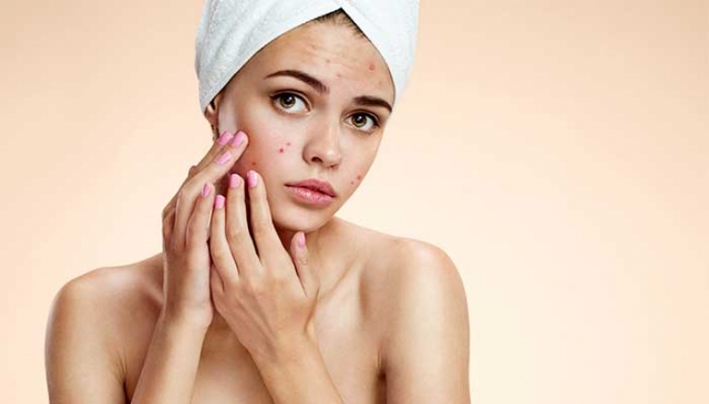 Seasonal Acne Care in Dubai: How to Manage Acne in Hot and Humid Conditions