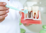 Mini Dental Implants in Dubai: Benefits and Costs