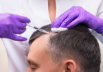 Exosomes Hair Regeneration Therapy at Halcyon Medispa