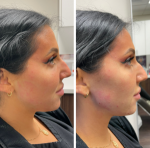 Jawline Augmentation by Dr. OBT at Halcyon Medispa