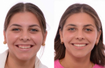 Gummy Smile Makeover Treatment in UK