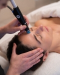 Microneedling for Acne Scarring: An In-Depth Look