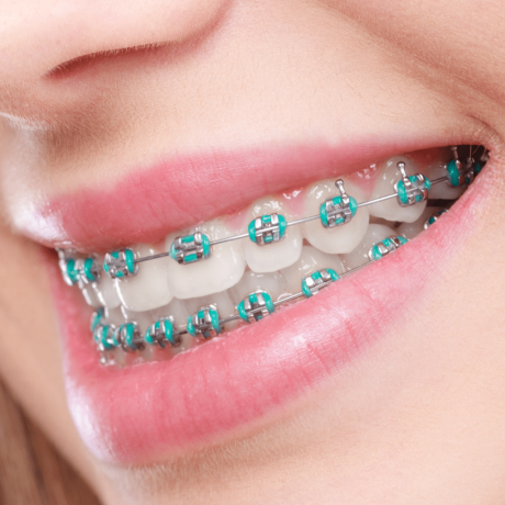 Why Dental Braces Are the Perfect Solution