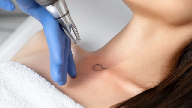 Say Goodbye to Ink Laser Tattoo Removal 