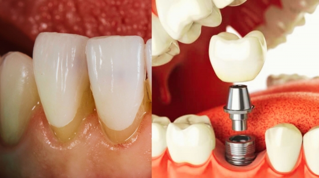 Bonding vs. Gum Grafting: Which is Right for You?